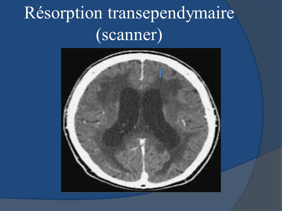 Résorption transependymaire (scanner)
