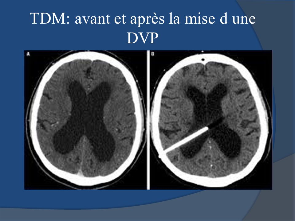 TDM: avant et après la mise d une DVP