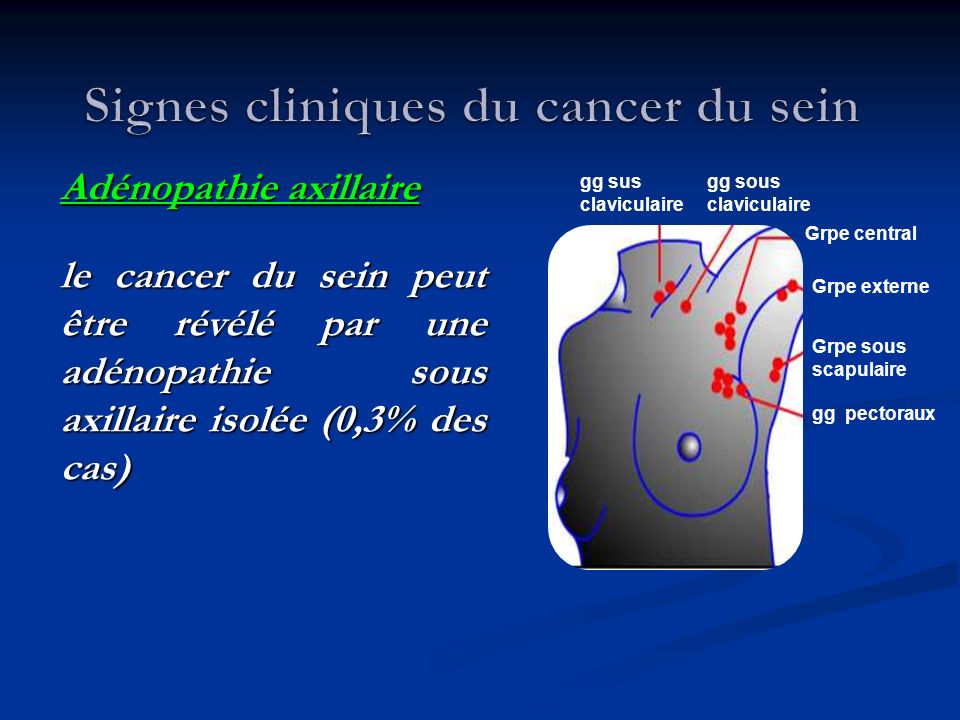 Signes cliniques du cancer du sein