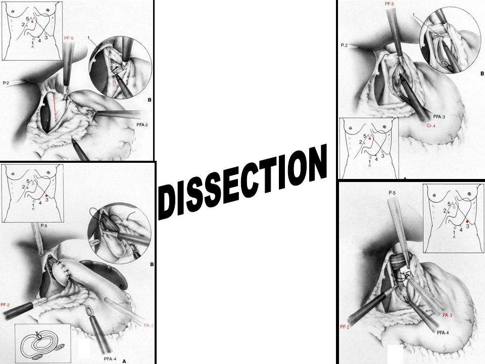DISSECTION