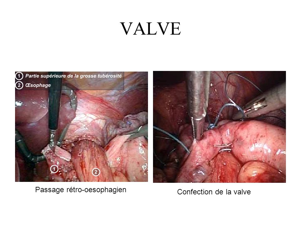 VALVE Passage rétro-oesophagien Confection de la valve