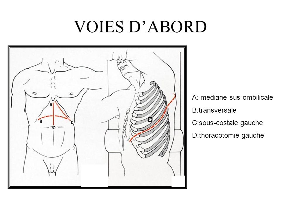 VOIES D’ABORD A: mediane sus-ombilicale B:transversale