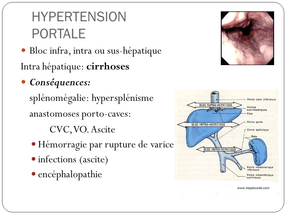 HYPERTENSION PORTALE Bloc infra, intra ou sus-hépatique