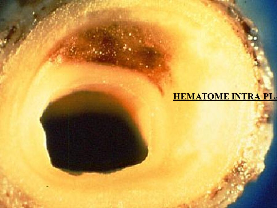 HEMATOME INTRA PLAQUE