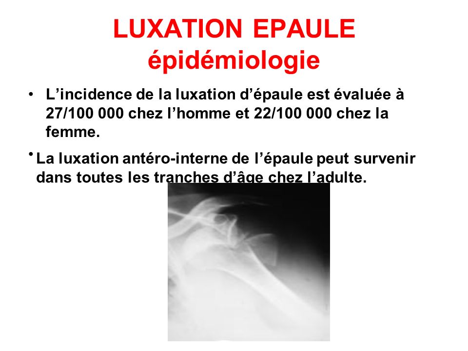 LUXATION EPAULE épidémiologie
