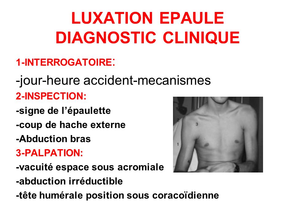 LUXATION EPAULE DIAGNOSTIC CLINIQUE