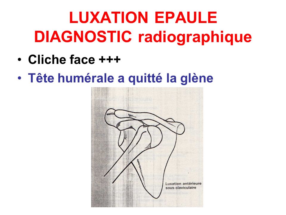 LUXATION EPAULE DIAGNOSTIC radiographique