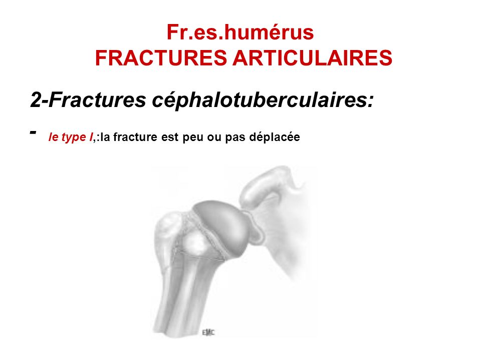 Fr.es.humérus FRACTURES ARTICULAIRES