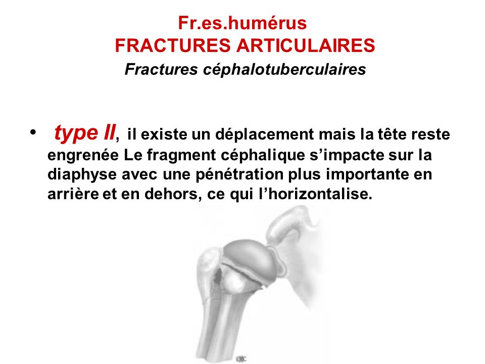 Fr.es.humérus FRACTURES ARTICULAIRES Fractures céphalotuberculaires