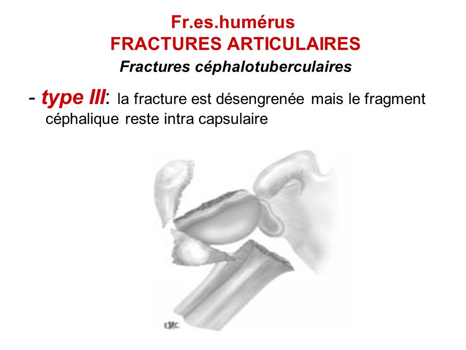 Fr.es.humérus FRACTURES ARTICULAIRES Fractures céphalotuberculaires