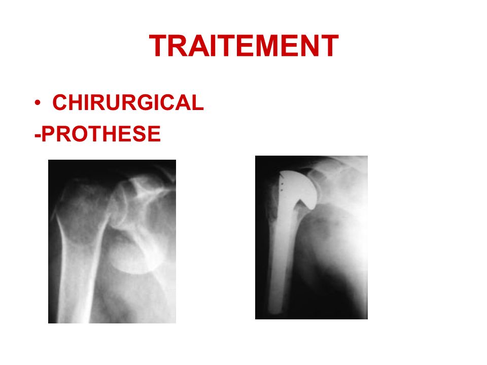 TRAITEMENT CHIRURGICAL -PROTHESE