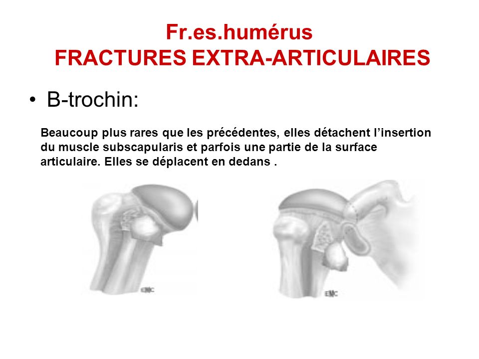Fr.es.humérus FRACTURES EXTRA-ARTICULAIRES