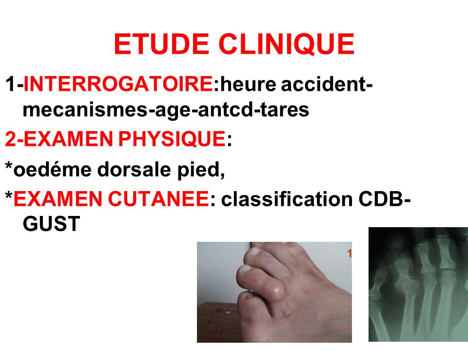 ETUDE CLINIQUE 1-INTERROGATOIRE:heure accident-mecanismes-age-antcd-tares. 2-EXAMEN PHYSIQUE: *oedéme dorsale pied,