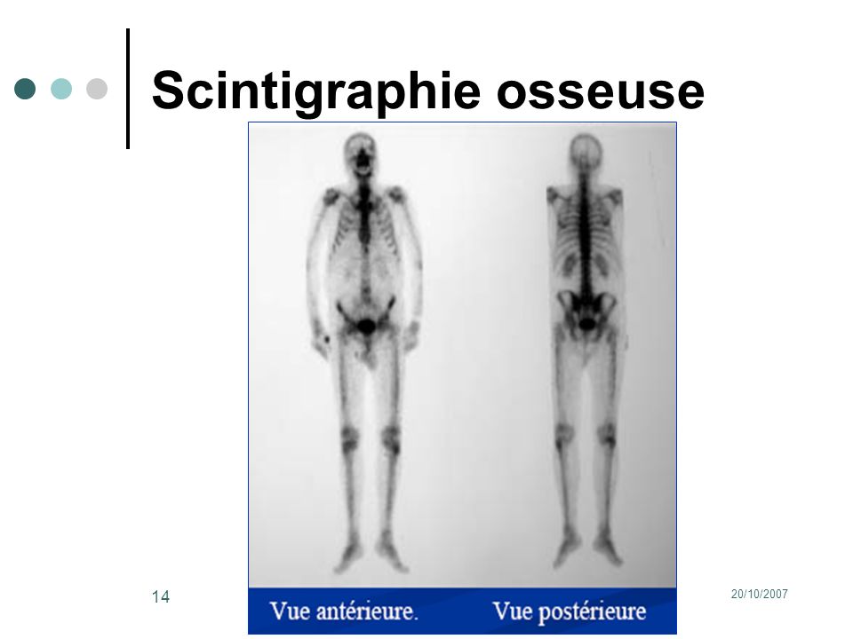 Scintigraphie osseuse