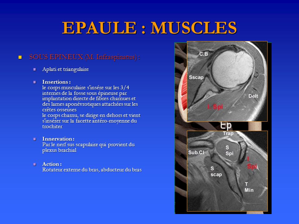 EPAULE : MUSCLES SOUS EPINEUX (M. Infraspinatus) :