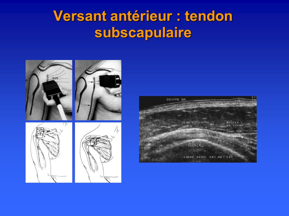 Versant antérieur : tendon subscapulaire