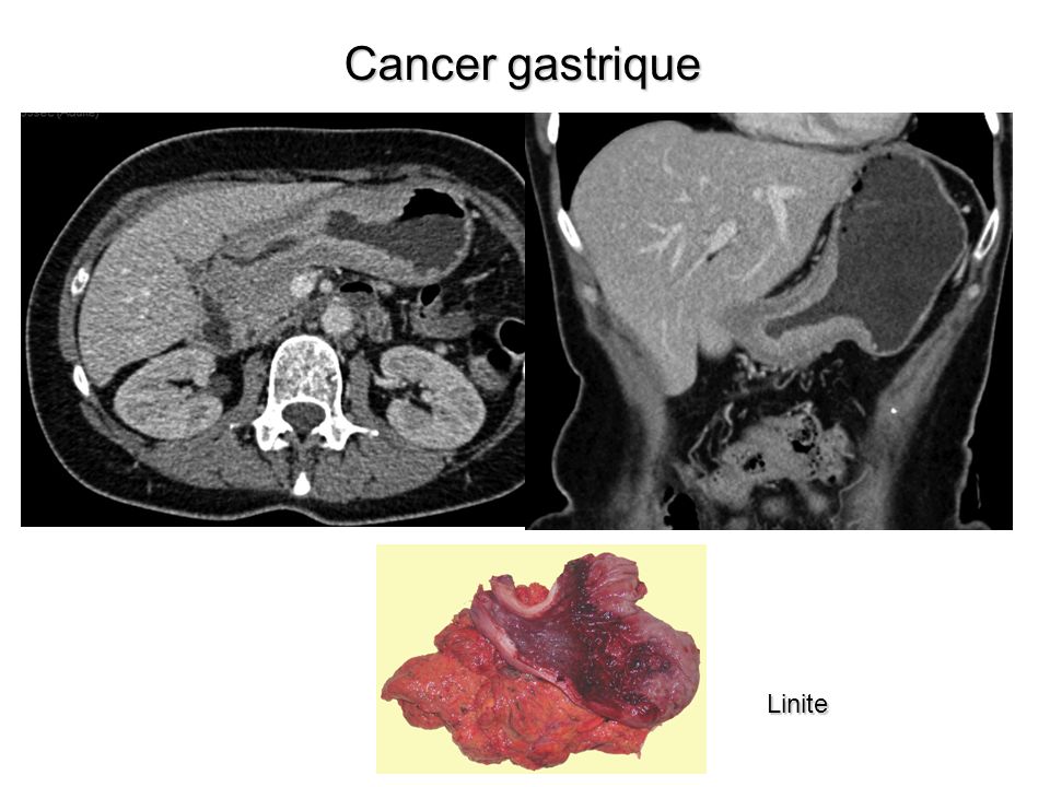 Cancer gastrique Linite