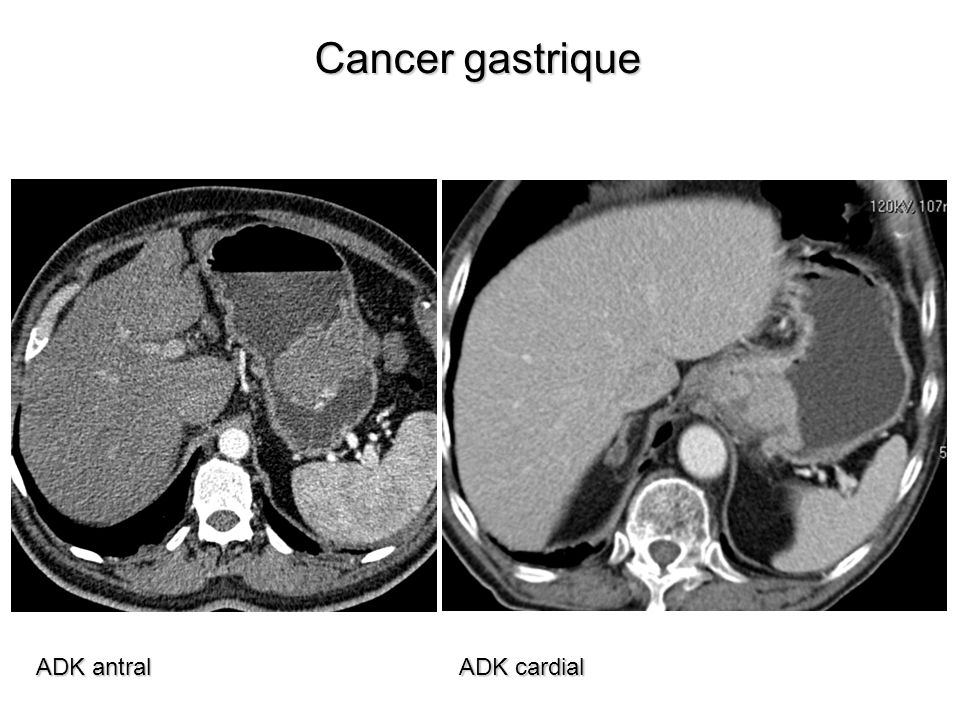 Cancer gastrique ADK antral ADK cardial
