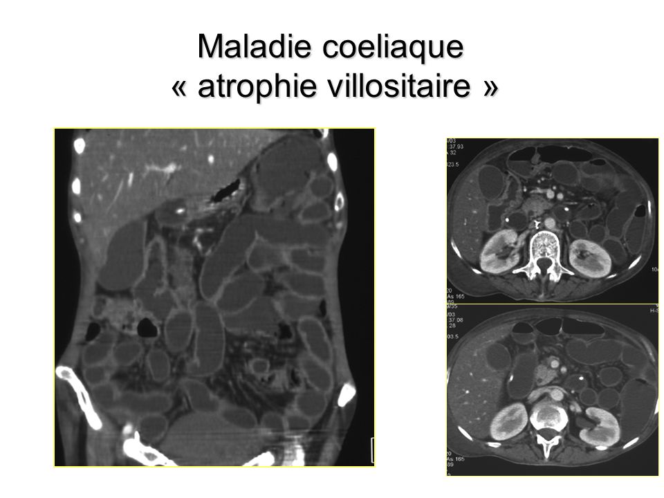 Maladie coeliaque « atrophie villositaire »
