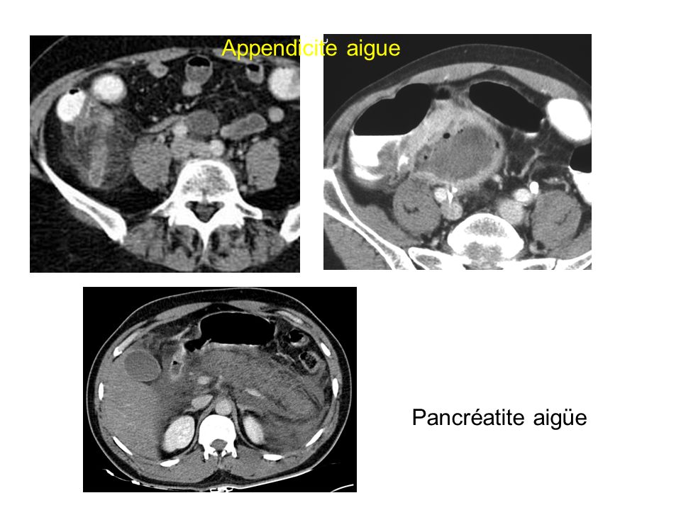 Appendicite aigue Pancréatite aigüe