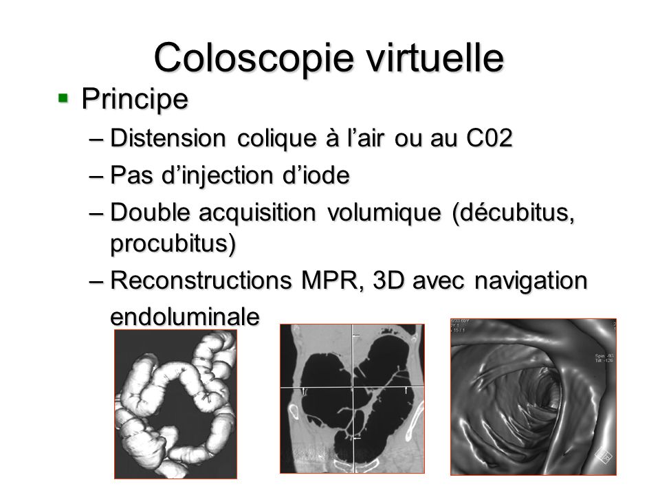 Coloscopie virtuelle Principe Distension colique à l’air ou au C02