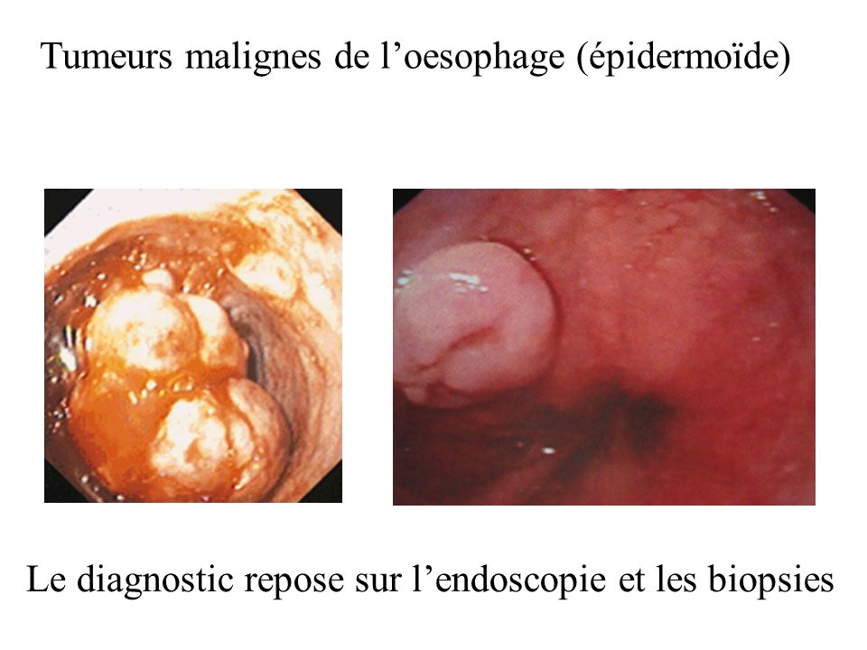 Tumeurs malignes de l’oesophage (épidermoïde)