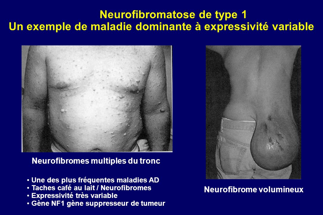 Neurofibromatose de type 1