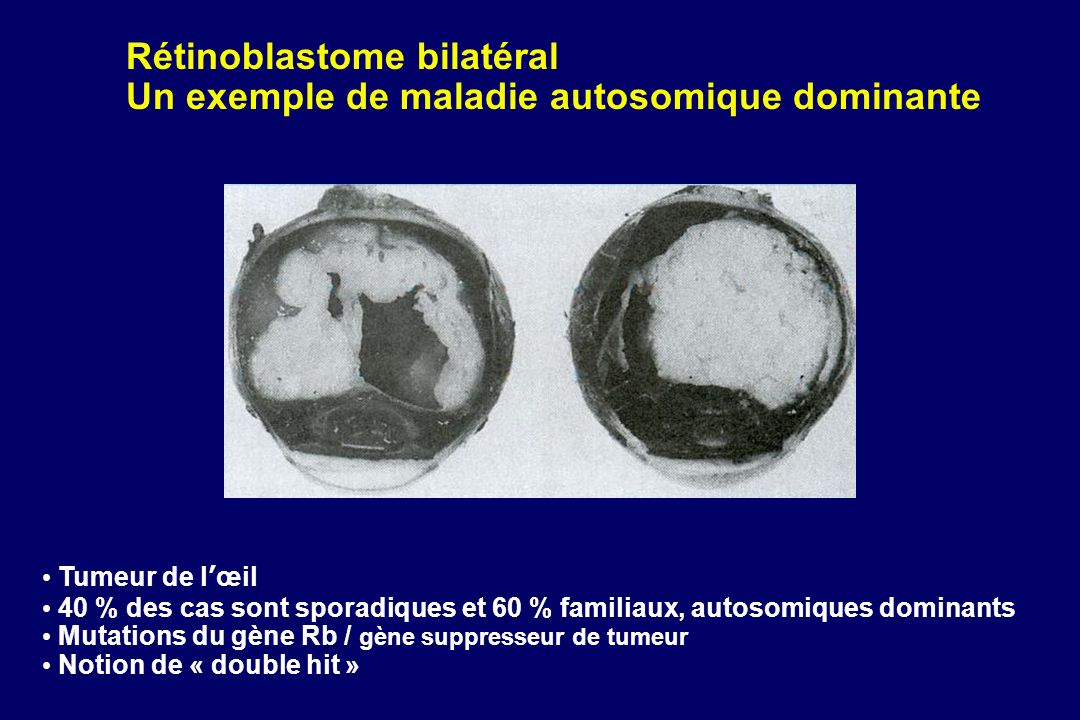 Rétinoblastome bilatéral Un exemple de maladie autosomique dominante