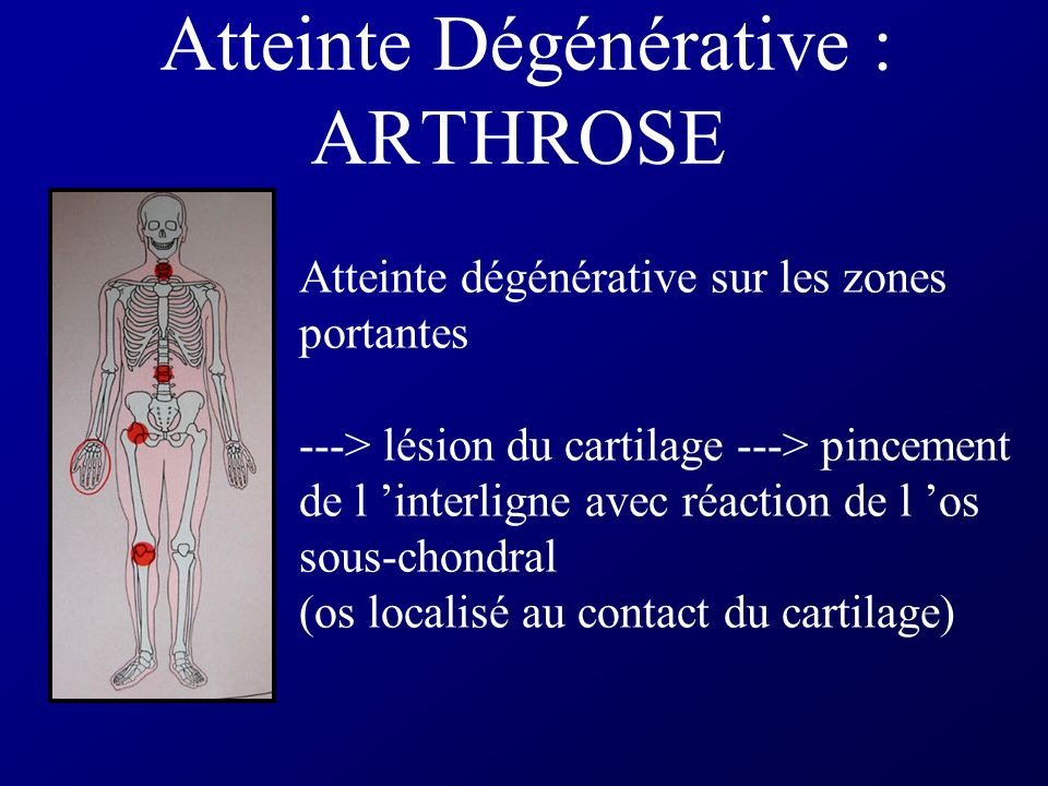 Atteinte Dégénérative : ARTHROSE