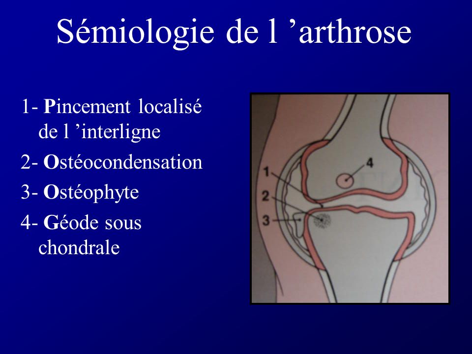 Sémiologie de l ’arthrose