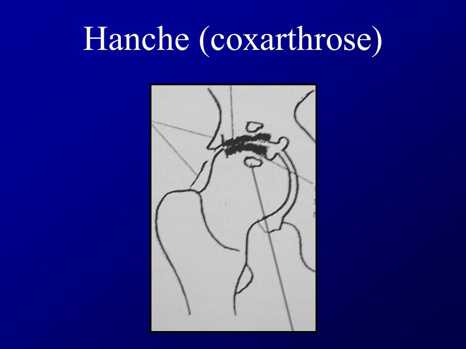 Hanche (coxarthrose)