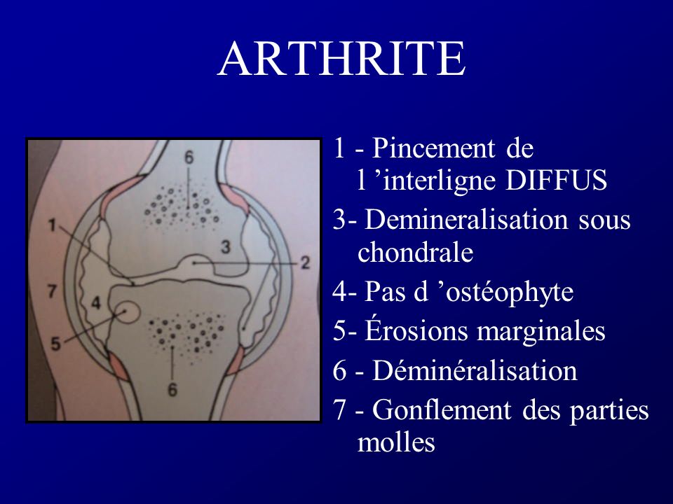 ARTHRITE 1 - Pincement de l ’interligne DIFFUS