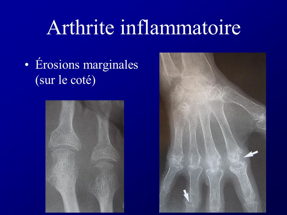 Arthrite inflammatoire