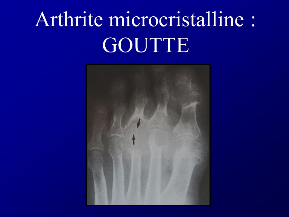Arthrite microcristalline : GOUTTE