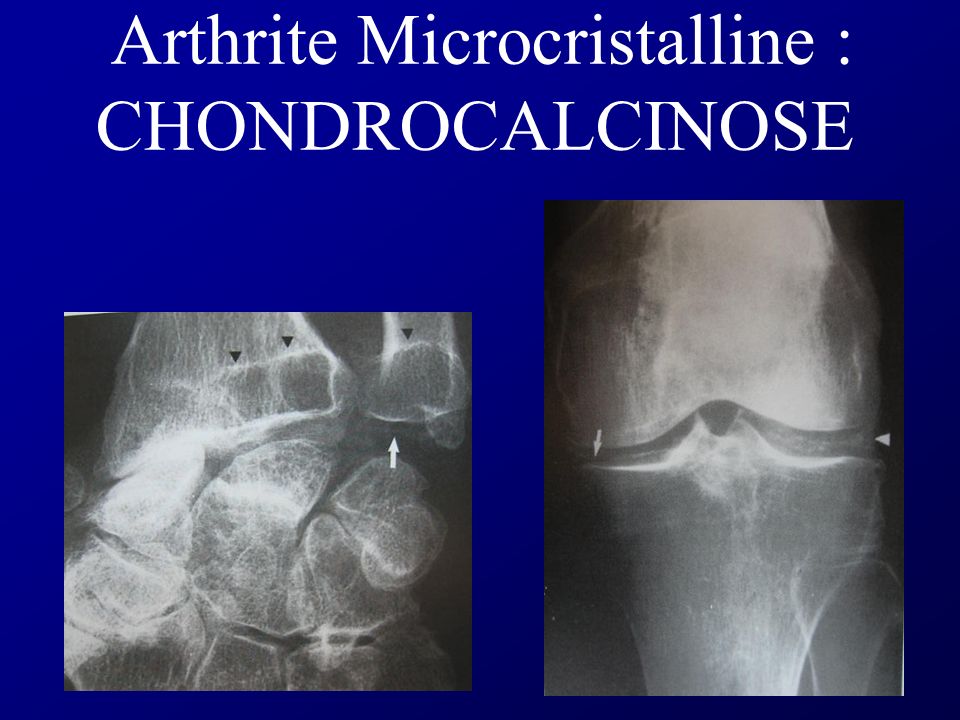 Arthrite Microcristalline : CHONDROCALCINOSE