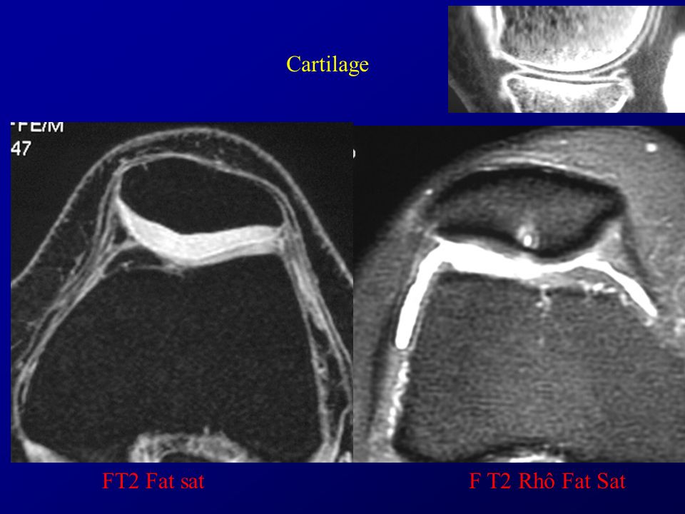 Cartilage FT2 Fat sat F T2 Rhô Fat Sat