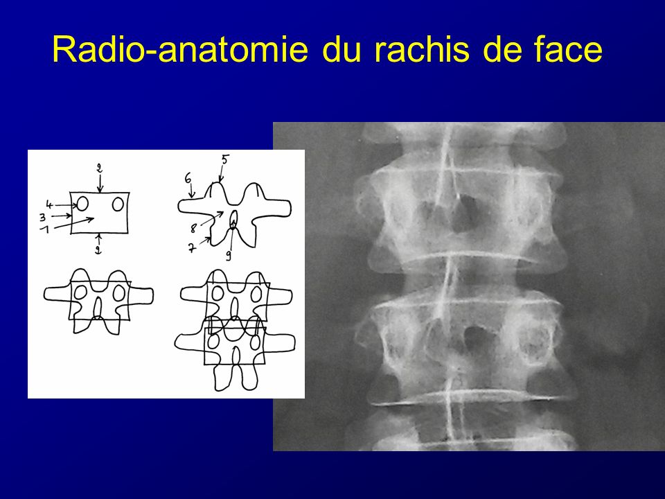 Radio-anatomie du rachis de face