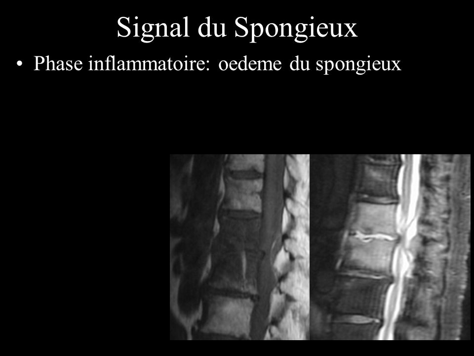 Signal du Spongieux Phase inflammatoire: oedeme du spongieux