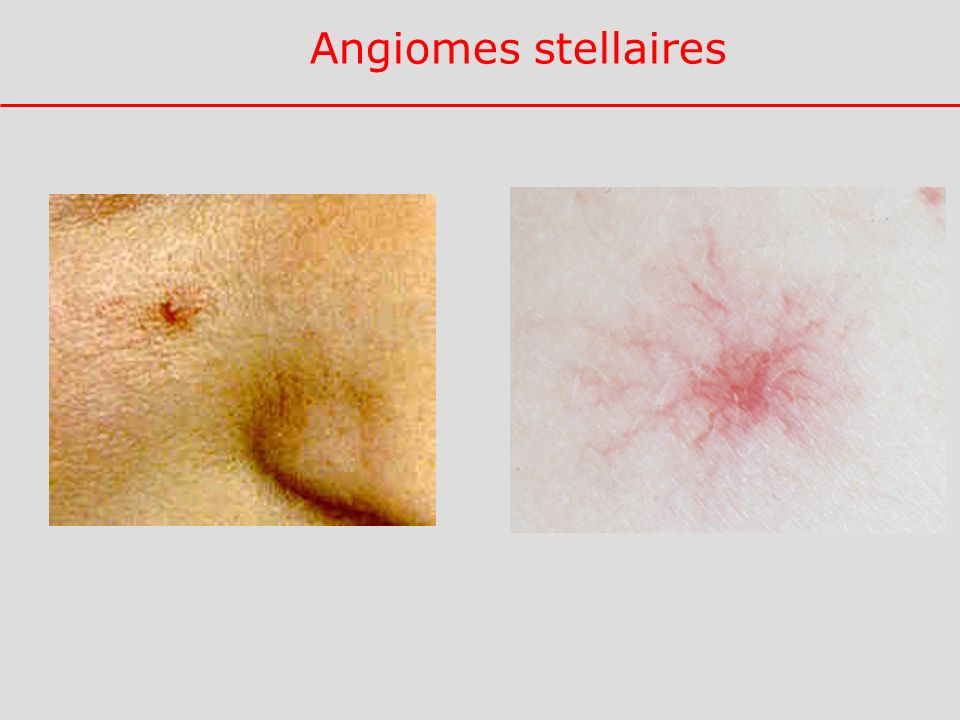 Angiomes stellaires