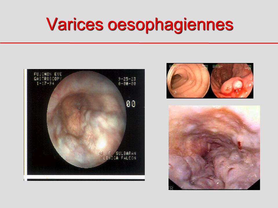 Varices oesophagiennes