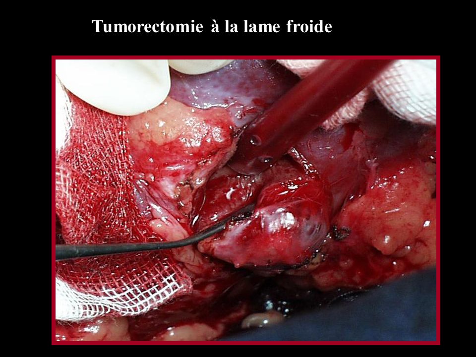 Tumorectomie à la lame froide