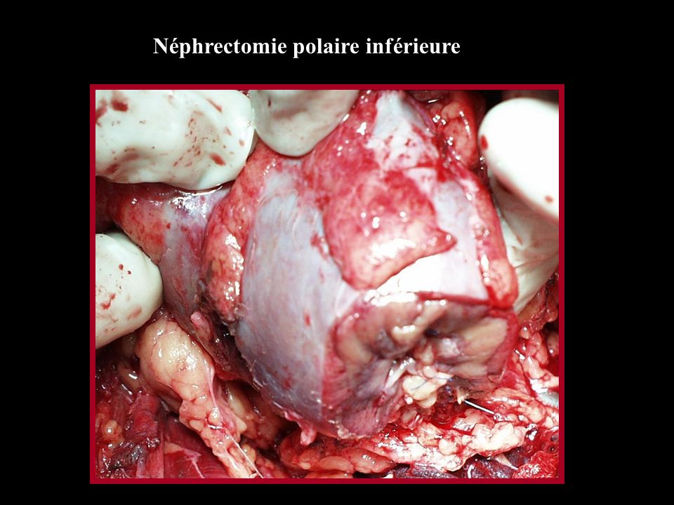 Néphrectomie polaire inférieure