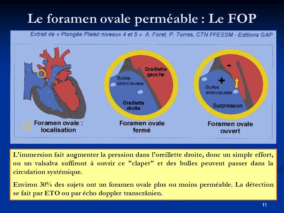 Le foramen ovale perméable : Le FOP