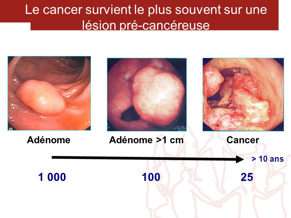 Le cancer survient le plus souvent sur une lésion pré-cancéreuse