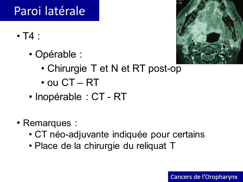 Paroi latérale T4 : Opérable : Chirurgie T et N et RT post-op