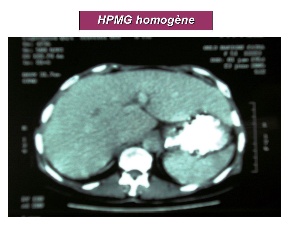 HPMG homogène