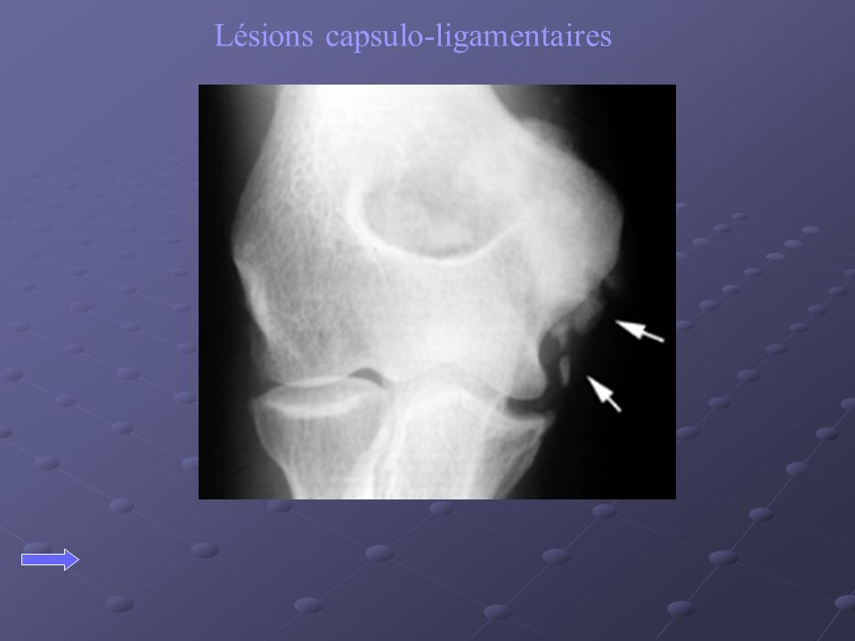 Lésions capsulo-ligamentaires