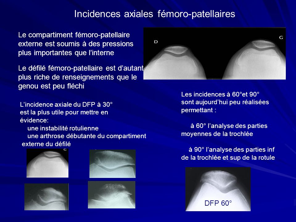 Incidences axiales fémoro-patellaires