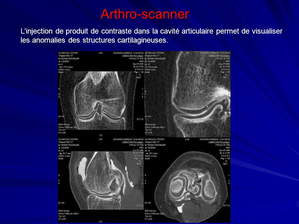 Arthro-scanner L’injection de produit de contraste dans la cavité articulaire permet de visualiser.