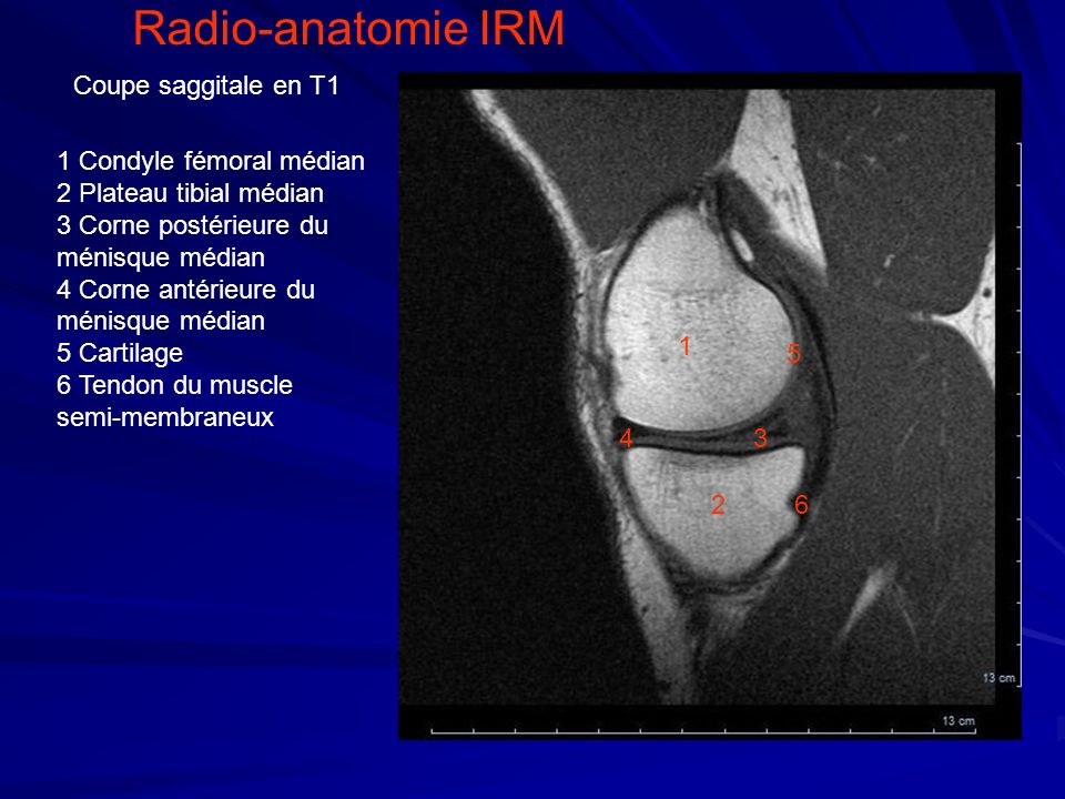 Radio-anatomie IRM Coupe saggitale en T1 1 Condyle fémoral médian